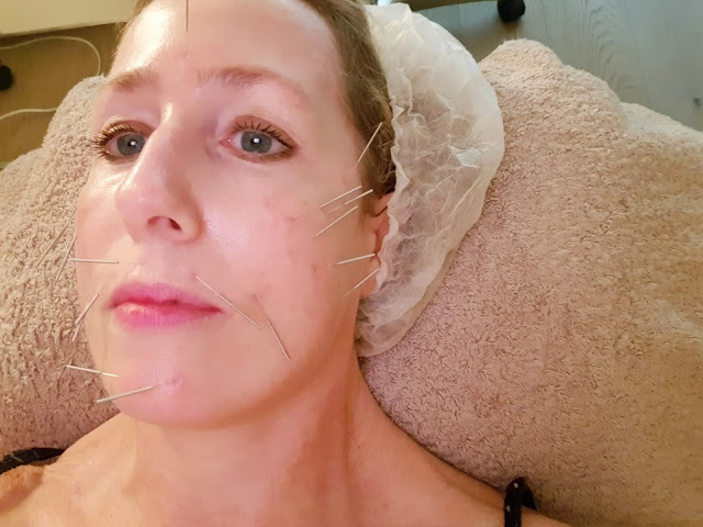 Acupuncture anti-âge