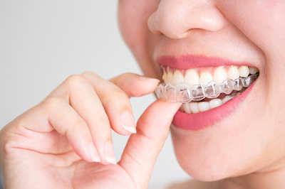 Ưu điểm của niềng răng invisalign