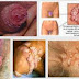 Obat Anti Kutil dan Perontok Kutil Kelamin thumbnail