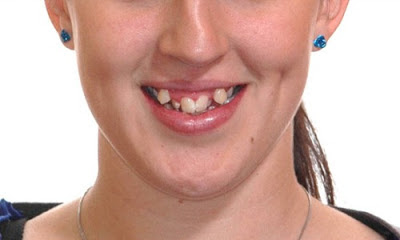 Giúp bạn hiểu đúng về ý nghĩa của răng khểnh