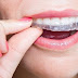Dịch vụ niềng răng trả góp cần thơ 