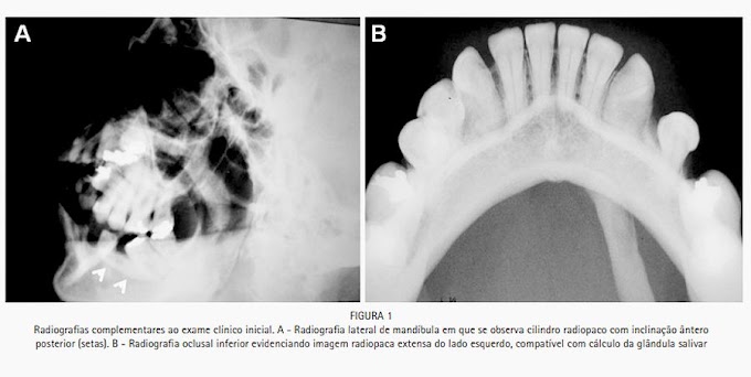 PDF: Sialolito de grandes dimensões no ducto da glândula submandibular