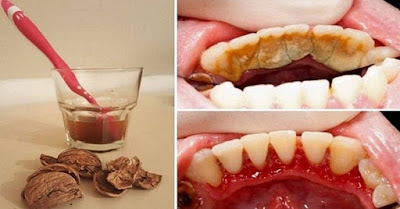 Get Rid Of The Tooth Scale Effectively and Painless! Very simple way!