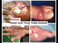 Obat Asam Urat Menyembuhkan Permanen