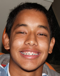 Damon Braces Treatment