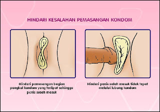 Cara Pakai Kondom  Wanita  Asuhan Keperawatan