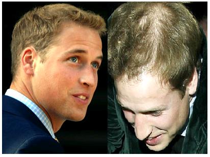 Hair Loss Baldness on How To Solve Hair Loss In Young Men Problem  Hair Loss In Young Men