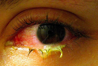 Treatment For Corneal Herpes : Genital Herpes Treatment Exactly Where Should It Begin