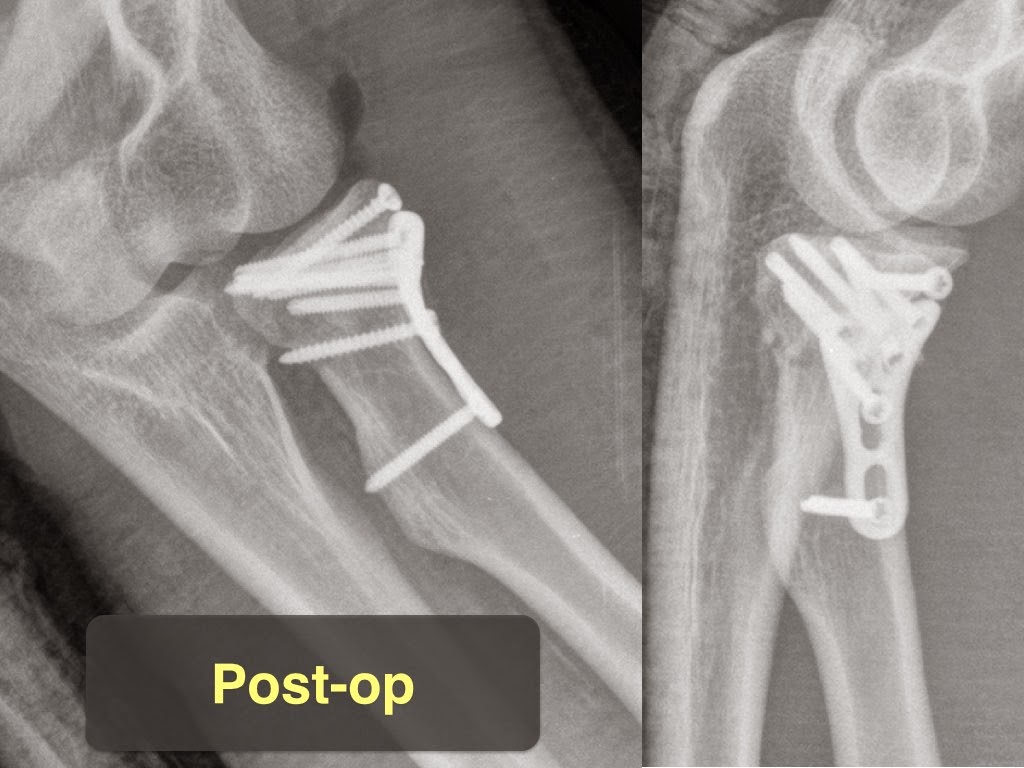 Chia Wei Lin Md 林佳緯醫師 手肘粉碎性橈骨頭骨折的治療 Treatment For Mason Iii Radial Head Fracture