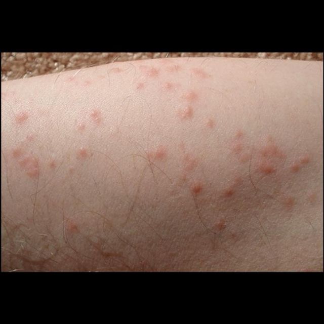 pictures of bed bug bites on skin