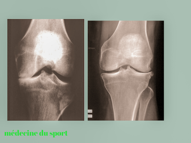 IMAGERIE DU GENOU APPLIQUÉE A LA PATHOLOGIE SPORTIVE (