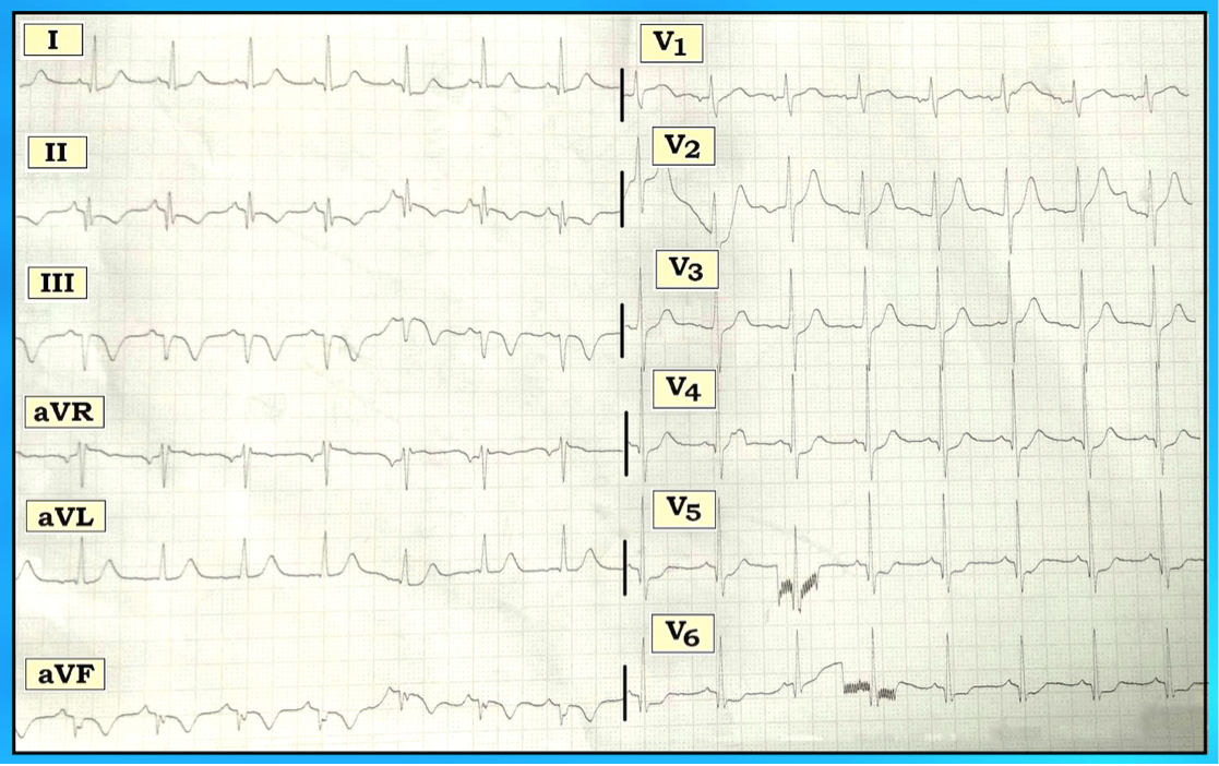 Ecg Interpretation Ecg Interpretation Review 142 Ischemia Mi