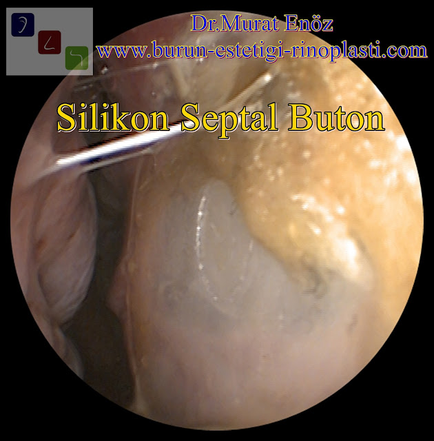 Silikon septal buton - Nazal septal buton - Septal buton uygulaması