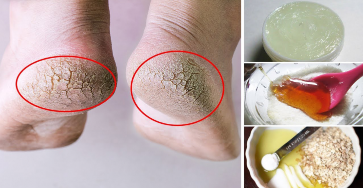 An Old Trick To Have Feet With Baby's Soft Skin, No Dry Skin Or Crevices