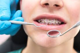 Dental braces, Process, Types and Fitting procedure