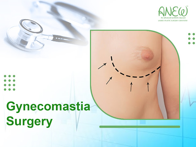 gynecomastia surgery in bangalore