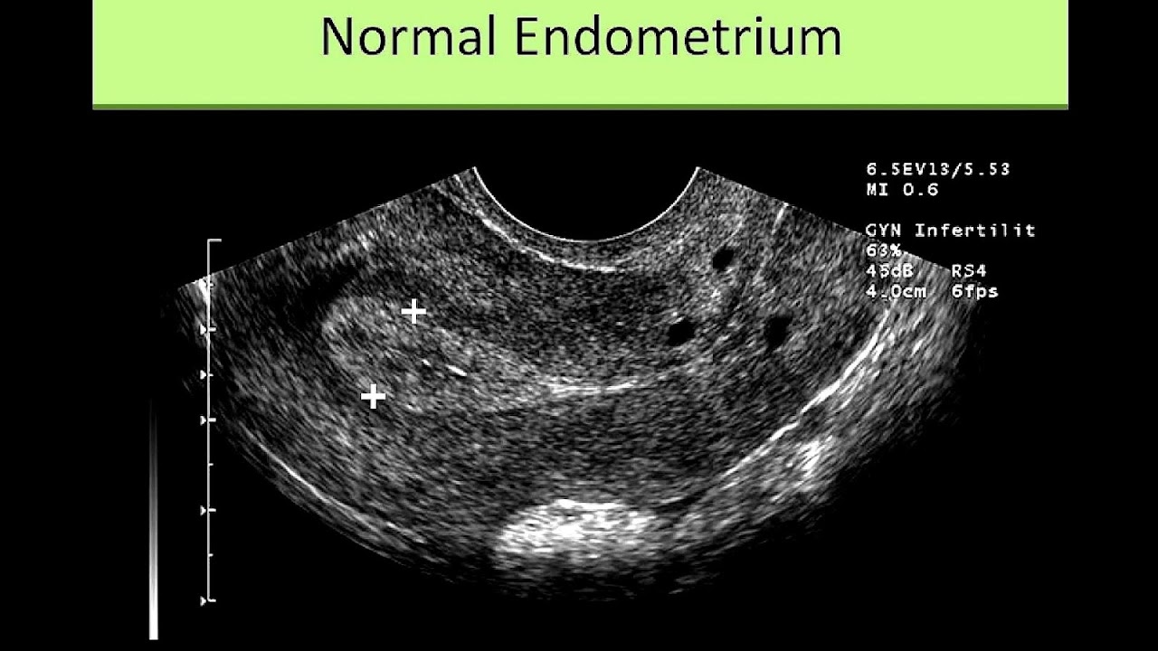 Thickness Of Uterine Lining After Menopause