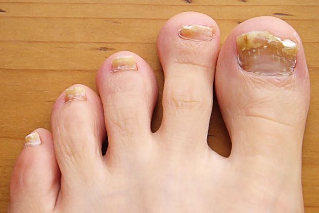 Understanding Toenail Fungus: Health Tip