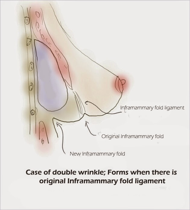 Double Bubble Boobs - What is it? How & Why This Deformity Occurs & How it  Can Be Fixed - Linia Cosmetic Surgery