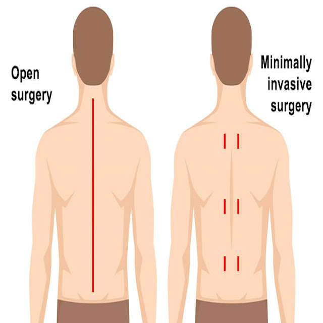 Why Minimally Invasive Spine Surgery is Beneficial?