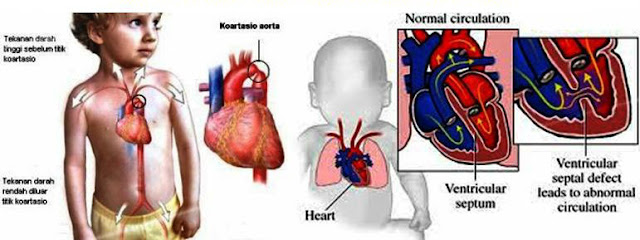 Kenali penyakit jantung berlubang pada bayi  Blog Tasly Sabah