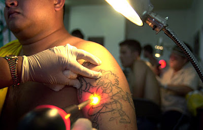 Laser Tattoo Removal