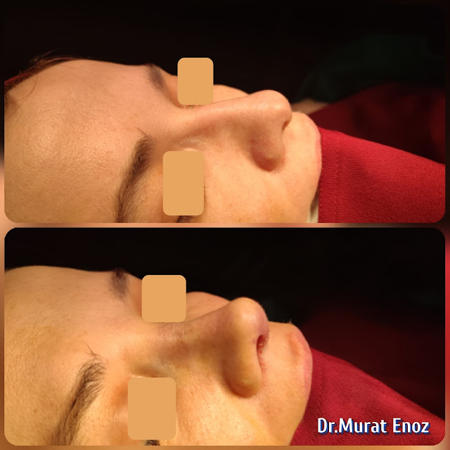 Micromotor Assisted Natural Rhinoplasty,Natural nose job for women, Simple rhinoplasty, Personal nose cosmetic procedure