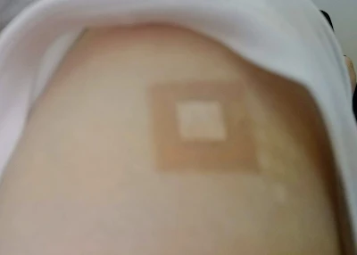 ワクチン接種後の腕の写真