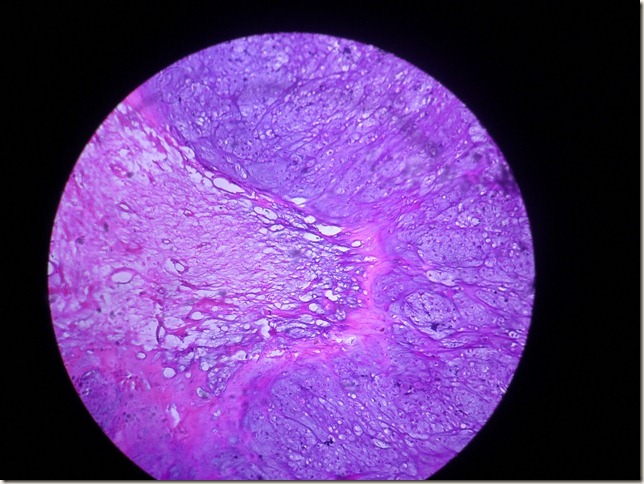 chondroma histopathology
