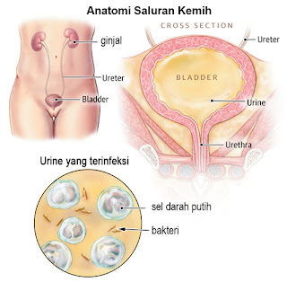 Cara Cepat Menyembuhkan Infeksi Saluran Kemih