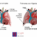 LA MUJER ES PRESA FACIL HIPERTENSION PULMONAR