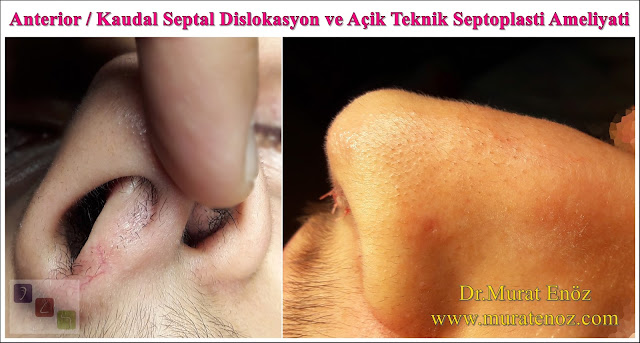 Kaudal septum deviasyonu nedir? - Kaudal septum deviasyonu belirtileri - Kaudal septum deviasyonu tedavisi - Kaudal septum deviasyonu ameliyatı - Kaudal septal deviasyon - Anterior septal deviasyon - Kaudal septoplasti - Açık teknik kaudal septum deviasyonu ameliyatı - Kaudal septum deviasyonu görselleri - Anterior septal dislokasyon - Açık teknik septoplasti ameliyatı - Açık teknik SMR ameliyatı - Açk teknik deviasyon ameliyatı