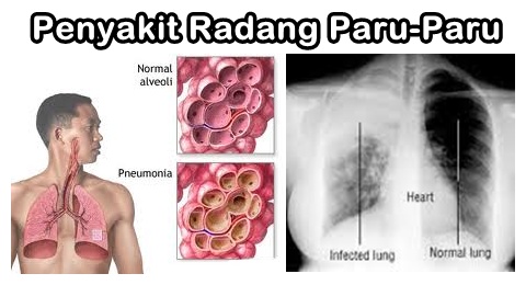  Cara  Mengobati  Radang Paru  Paru  Terbaik Cara  Mengobati  