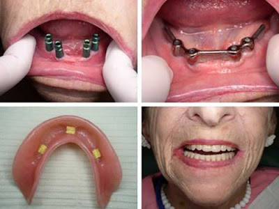  Implant cho người cao tuổi mất nhiều răng