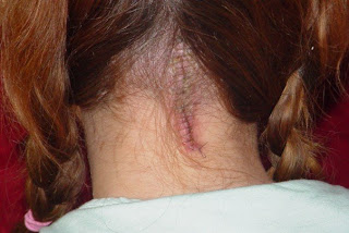 Chiari Malformation surgery scar