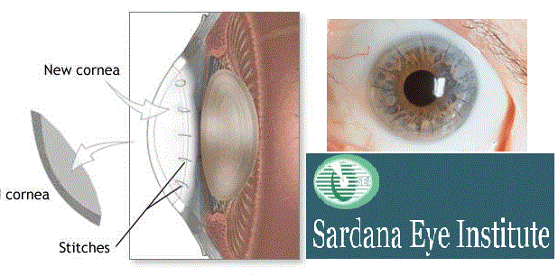 Keratoconus-Treatment 