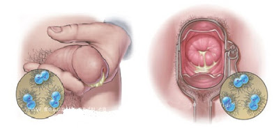 مرض السيلان المنقول جنسيا Gonorrhea