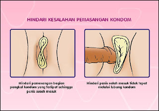 kondom buat wanita