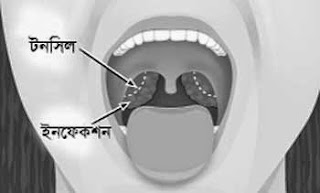 টনসিল ইনফেকশনের জন্য ভাইরাস দায়ী 