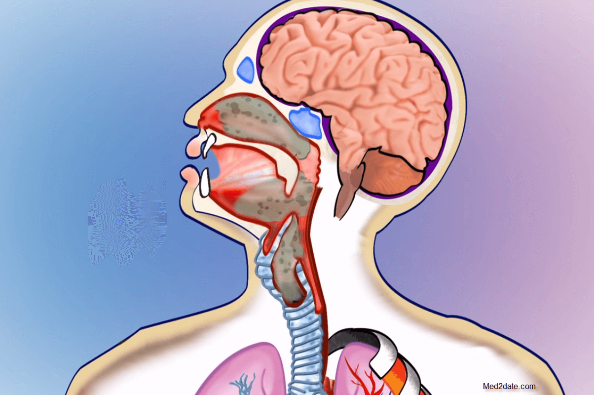 Diphtheria-Pharyngitis