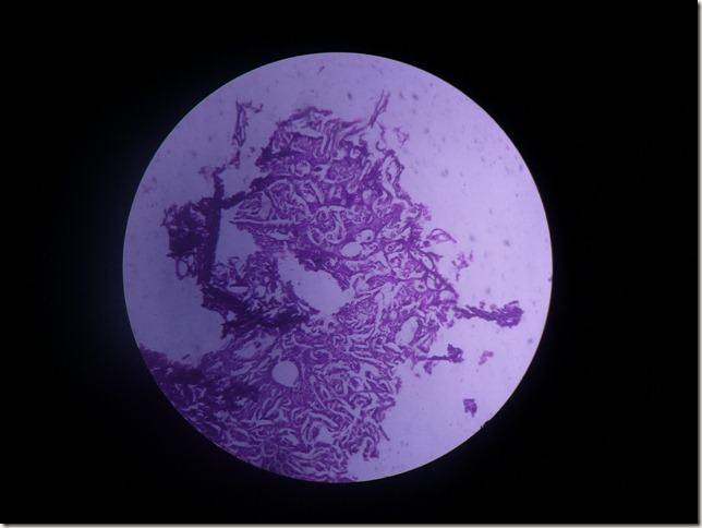 CA prostate