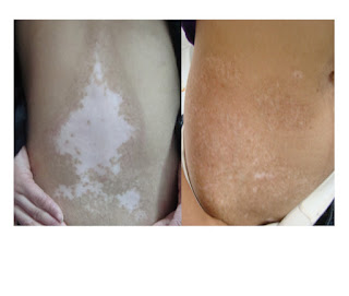 Is Leucoderma/Vitiligo Curable?