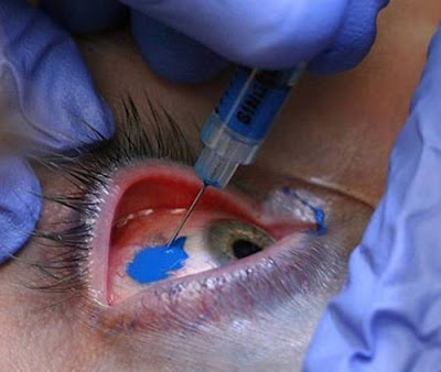 Eyeball Tattoo Corneal tattooing is not only possible, but it has been known 