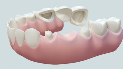  Quy trình làm cầu răng sứ  tại nha khoa