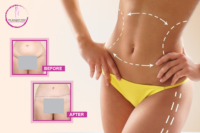 liposuction cost in JPNagar