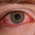 هل العين الوردية Pink eye واحدة من أعراض مرض كوفيد -19؟ هل العين الوردية Pink eye واحدة من أعراض مرض كوفيد -19؟