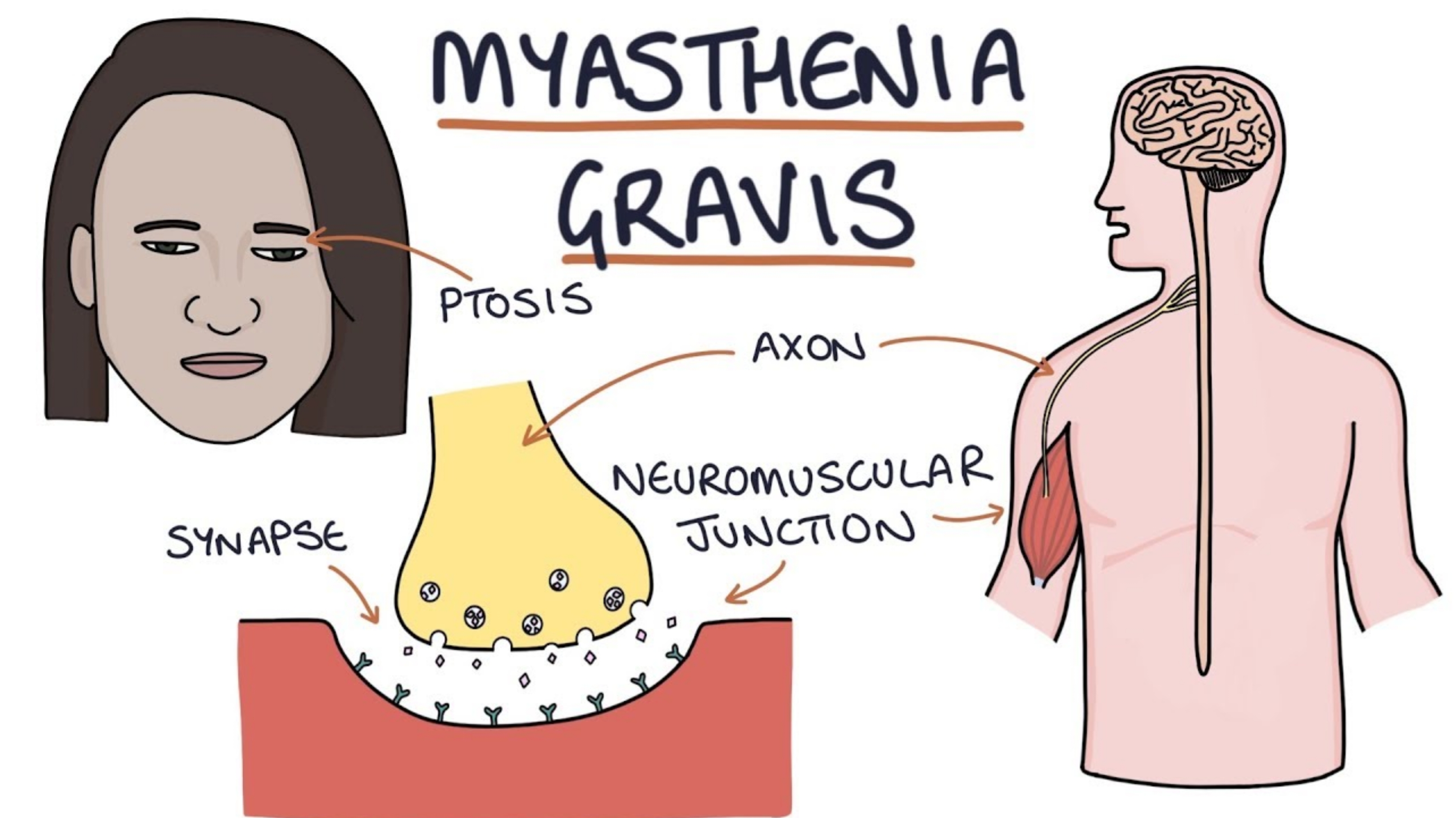 https://www.healthandfitnessexpert.in/2024/04/what-is-myasthenia-gravis-and-is-there.html