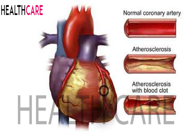 Cardiovascular Disease: The silent killer
