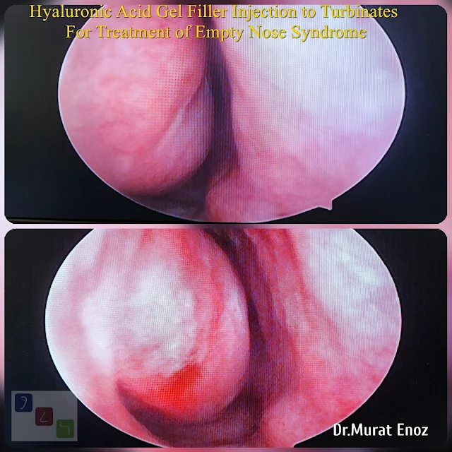 Hyaluronic acid injection in Treatment of Empty Nose Syndrome,Hyaluronic acid injection for Treatment of Empty Nose Syndrome,Empty Nose Syndrome,Turbinate filling with hyaluronic acid,
