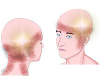 Dor de cabeça - cefaléia tensional